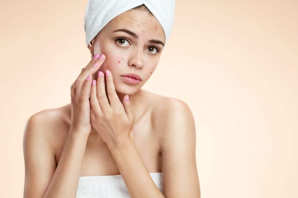 How To Get Rid Of Acne – Acne Treatments Near Me | South Ogden, UT | Timeless Skin and Wellness