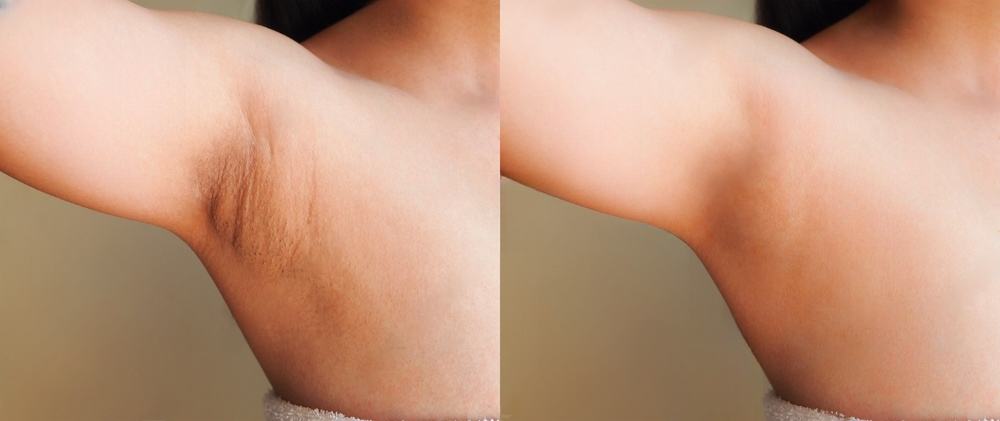 Before And After Inimate Skin Brightening | South Ogden, UT | Timeless Skin and Wellness