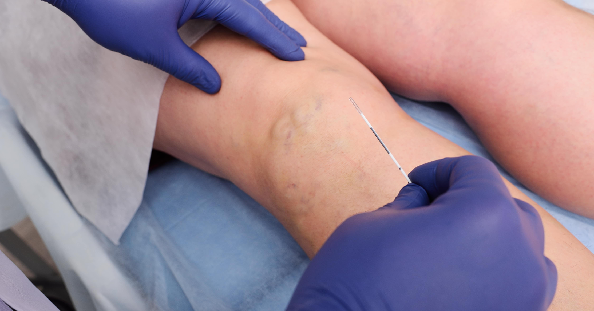 Medical professional wearing blue gloves performing a spider vein treatment on a patient's leg using a fine needle, likely during a sclerotherapy procedure in South Ogden, UT