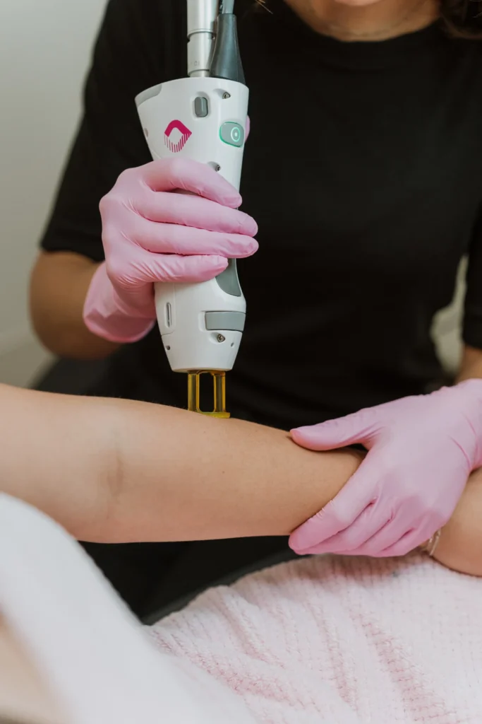 Close-up of a technician in pink gloves performing laser hair removal on a client’s forearm using a handheld laser device.