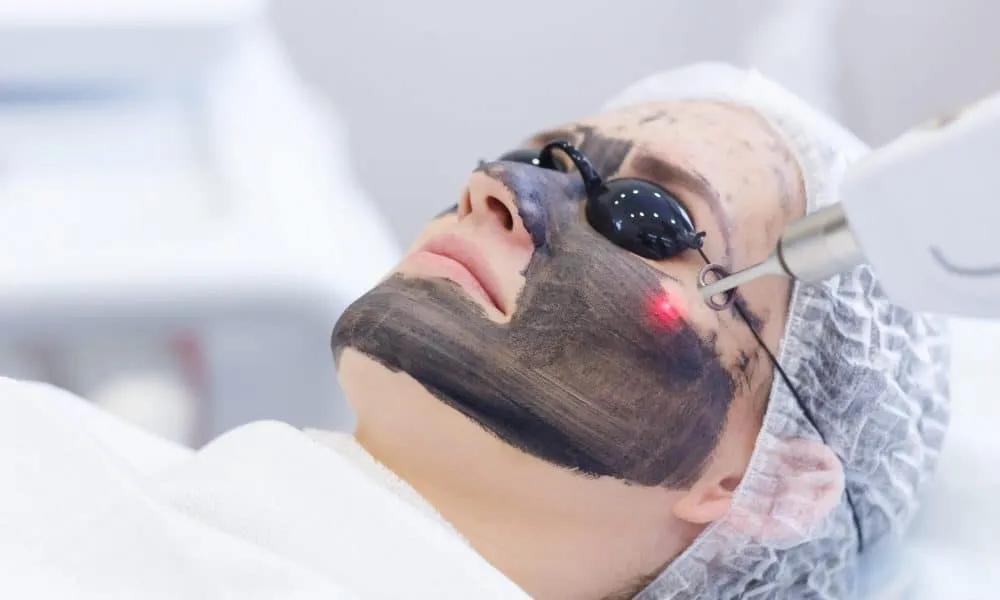 Timeless Skin and Wellness charcoal laser peel facial treatment