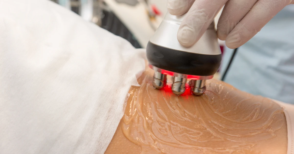 Candela RF treatment in South Ogden & North Logan
