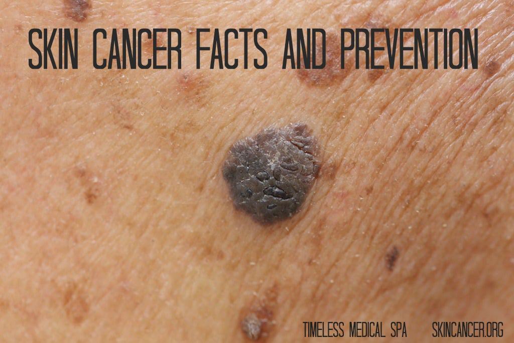 Skin Cancer Facts and Prevention | South Ogden, UT | Timeless Skin and Wellness